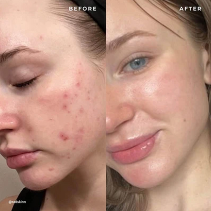 BP 10% Acne Medication Gel