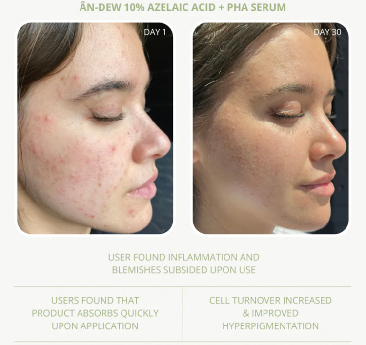 ÂN-DEW 10% Azelaic Acid + PHA Serum